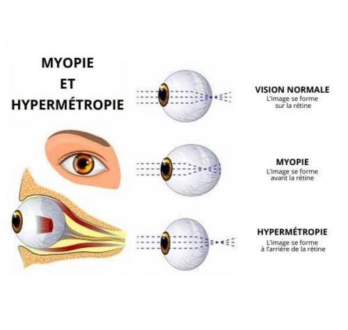 Myopie et Hypermétropie